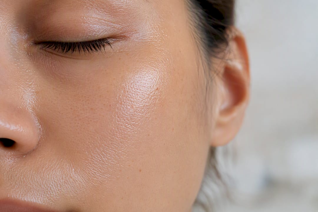 Close-up of acne-prone skin texture and pores