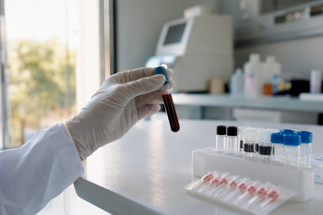 Gloved hand holding blood sample for food sensitivity test