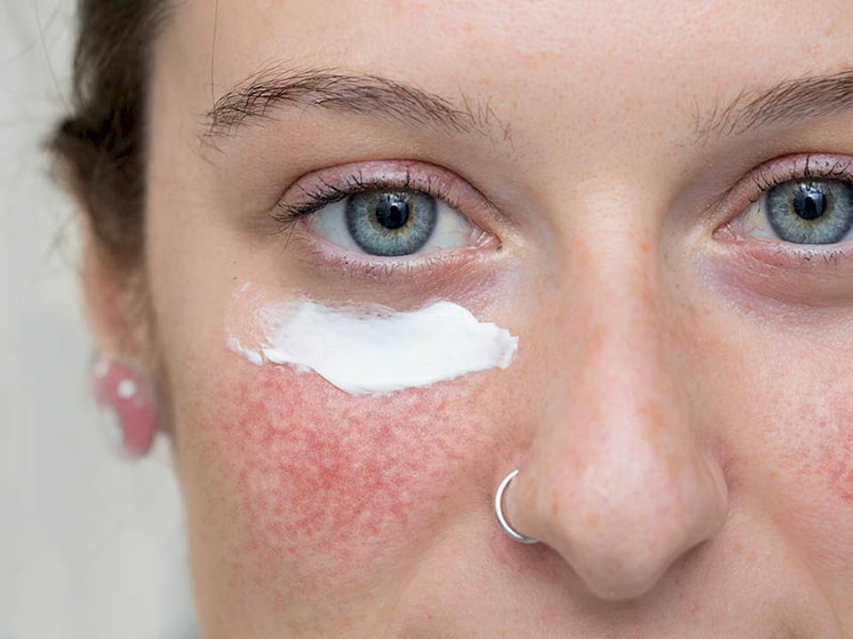 Rosacea Skincare | Cleansers, Moisturisers & Sunscreen