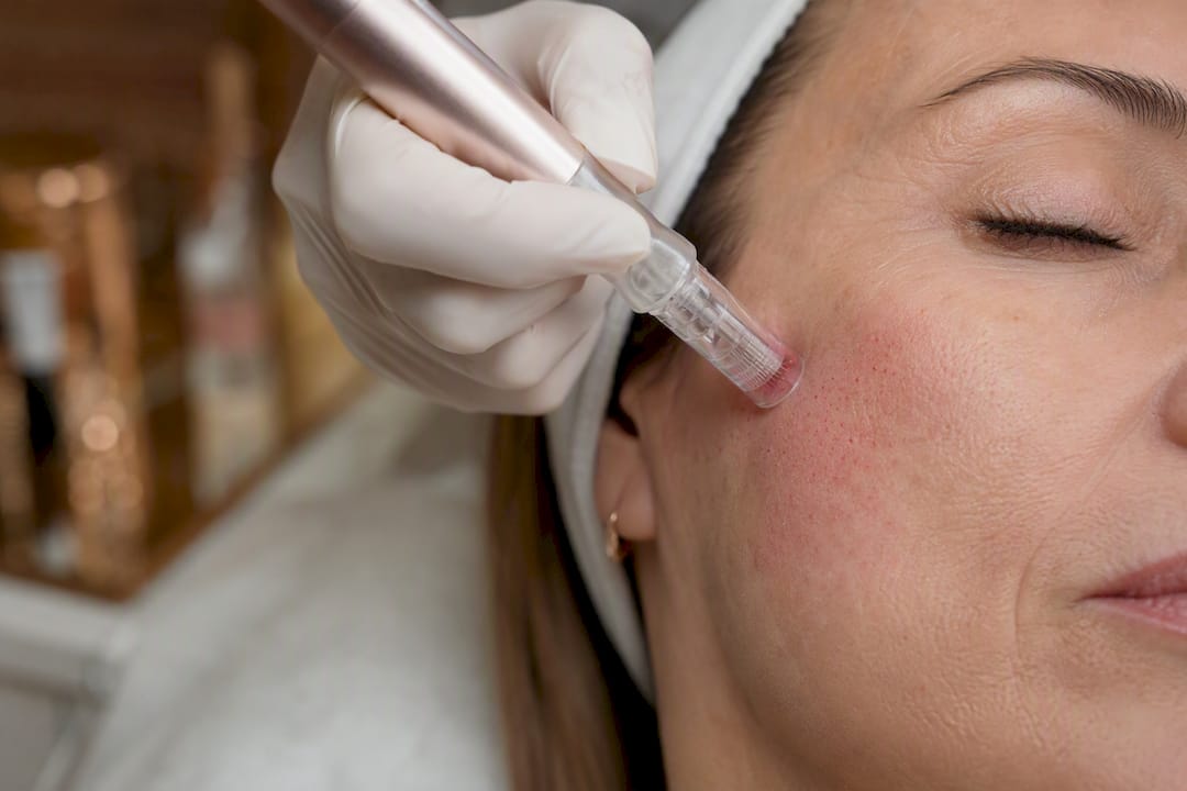 Close-up of microneedling procedure on cheek