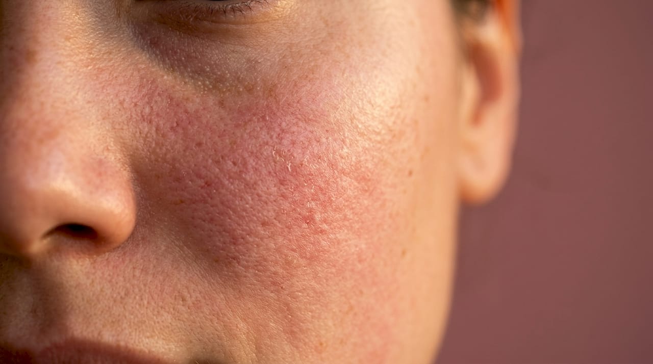 Close-up of mildly inflamed red skin on cheek