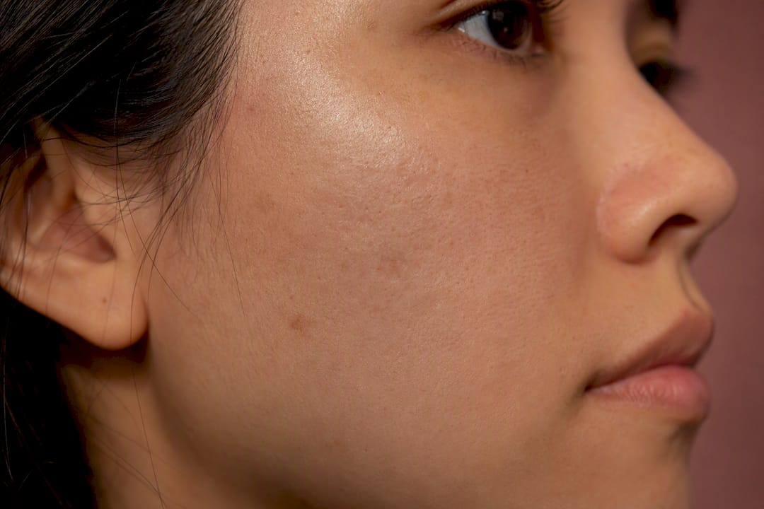 Close-up of healed cheek skin texture