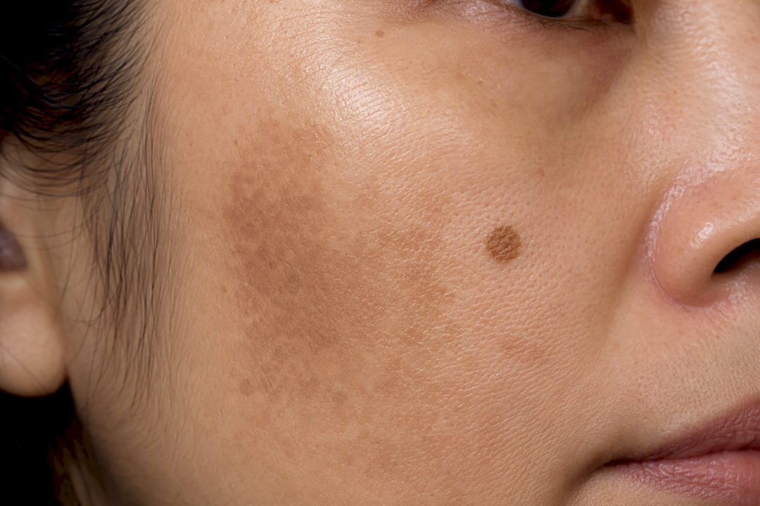 Close-up skin with melasma and sunspot