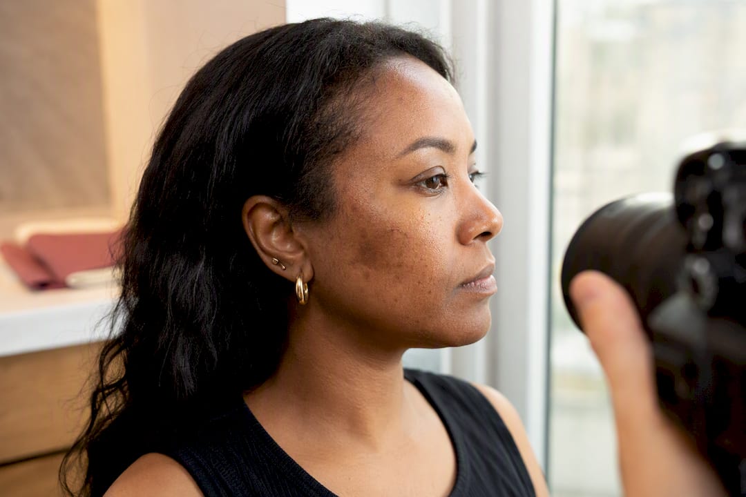 Darker skin cheek photographed for pigmentation follow-up