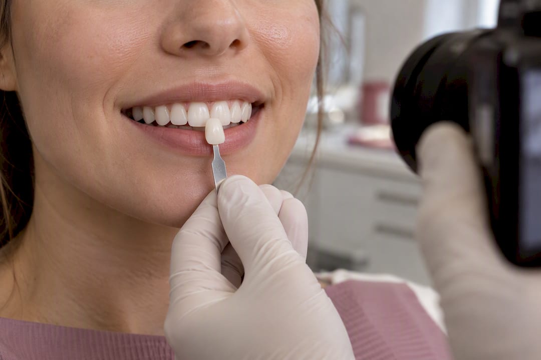 Clinician photographing shade tab beside teeth