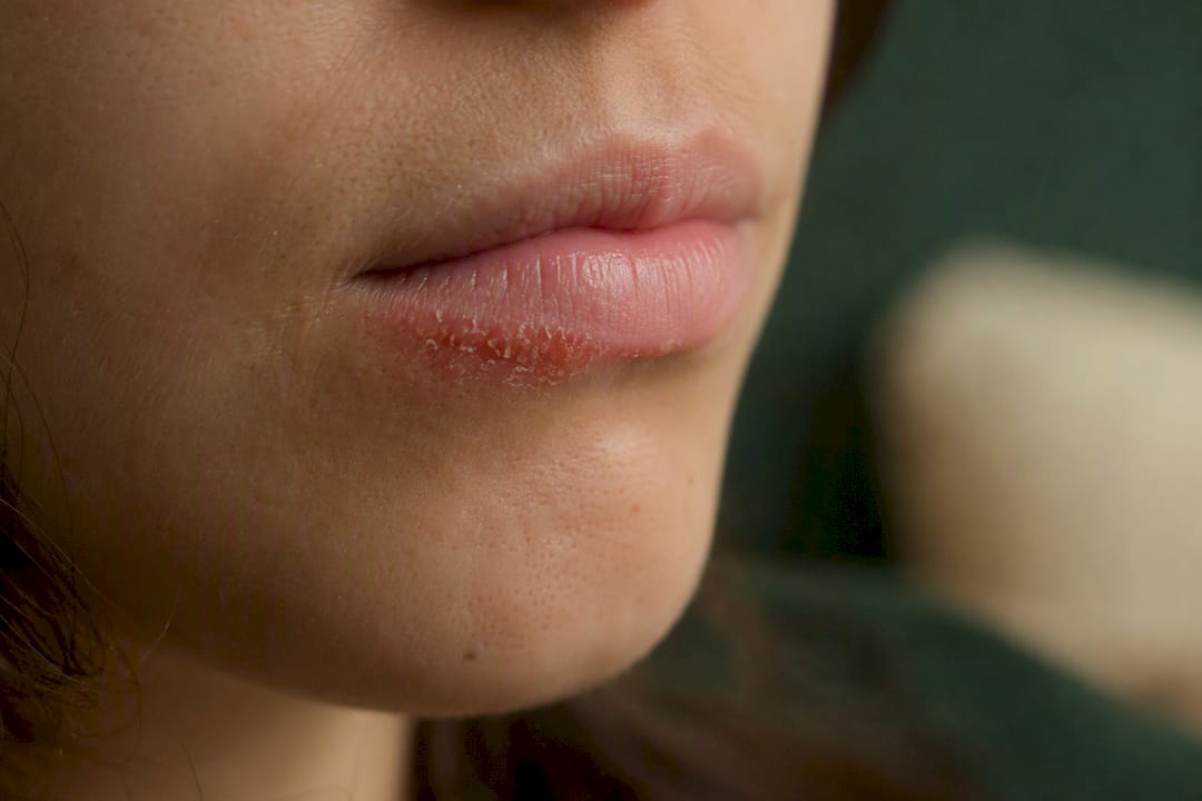 Lips with clear lip licking dermatitis border