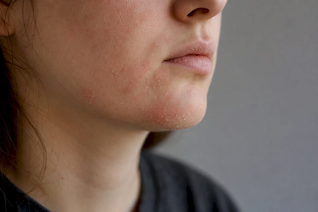 Close-up of dry, flaky, and irritated facial skin