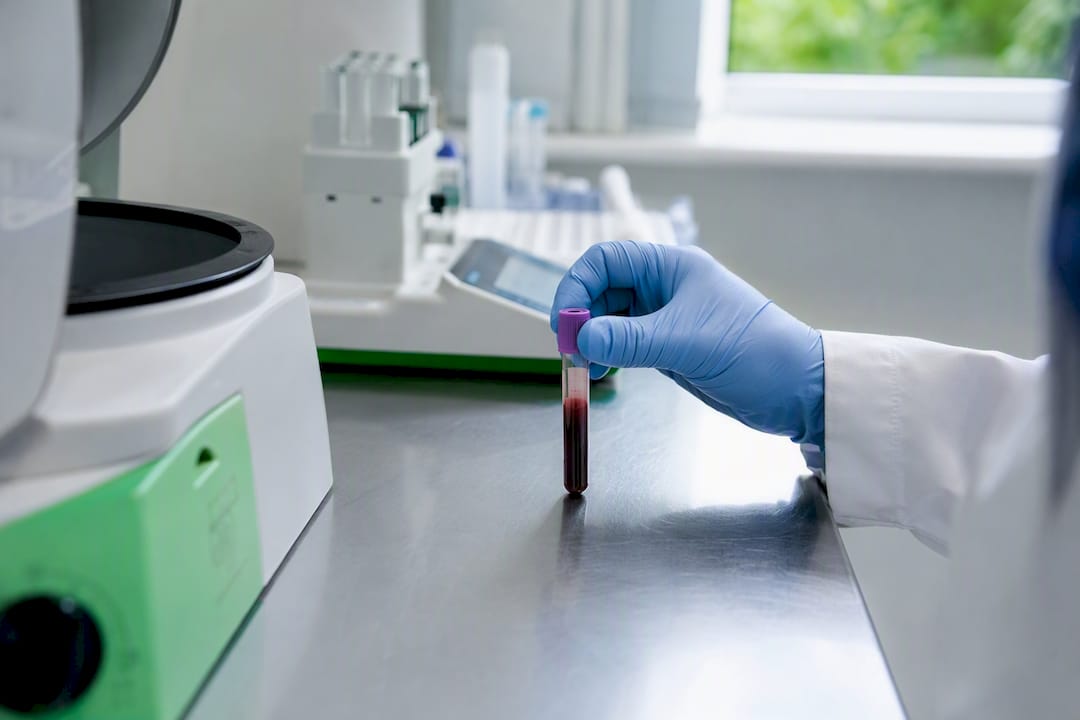 Vial de sangre en laboratorio para análisis de ferritina
