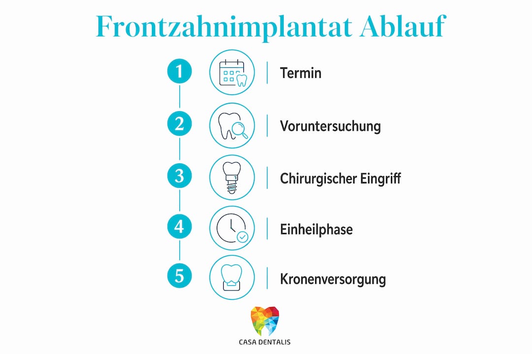 Grafische Übersicht: So läuft die Behandlung mit einem Frontzahnimplantat Schritt für Schritt ab
