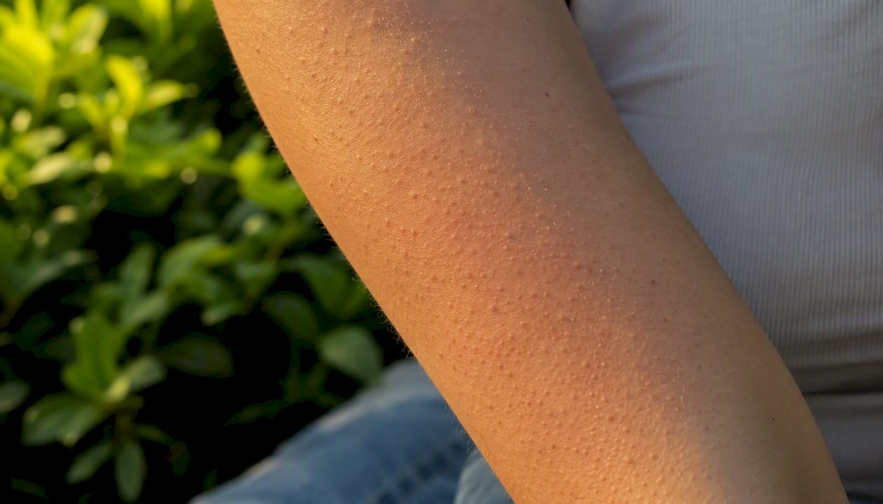 Close-up of keratosis pilaris bumps on arm skin