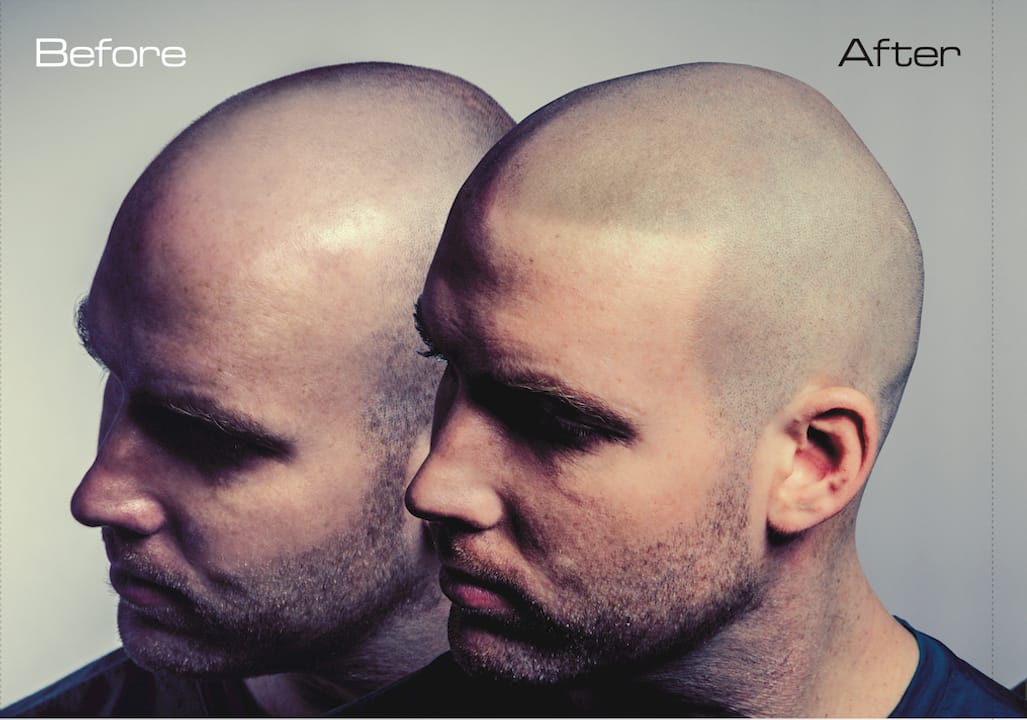 Infographic comparing non-invasive hair loss treatments