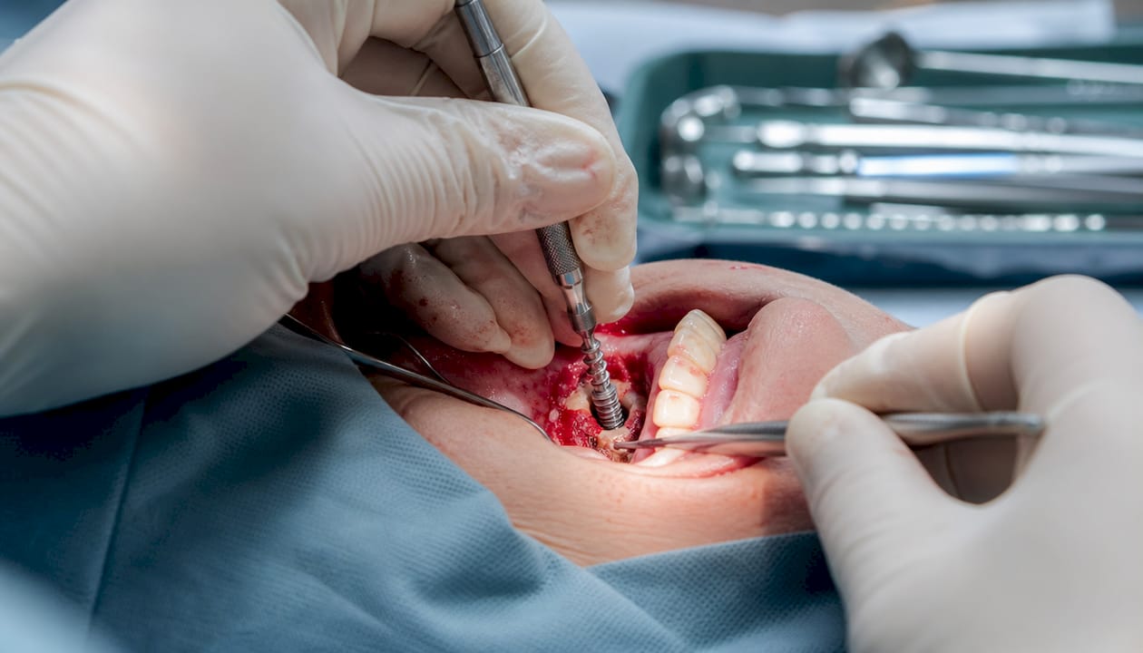 Dentist hands placing dental implant during surgery