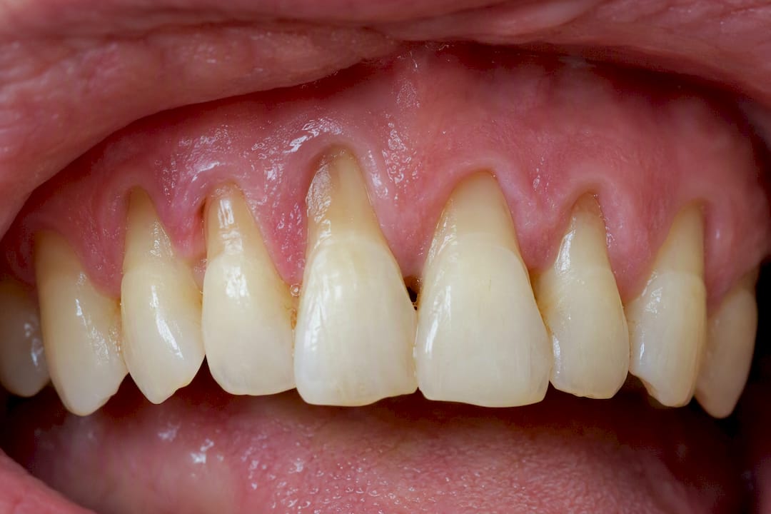 Close-up of receding gums and exposed tooth roots