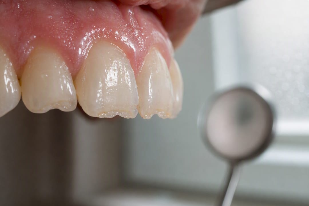 Close-up of acid erosion on front teeth