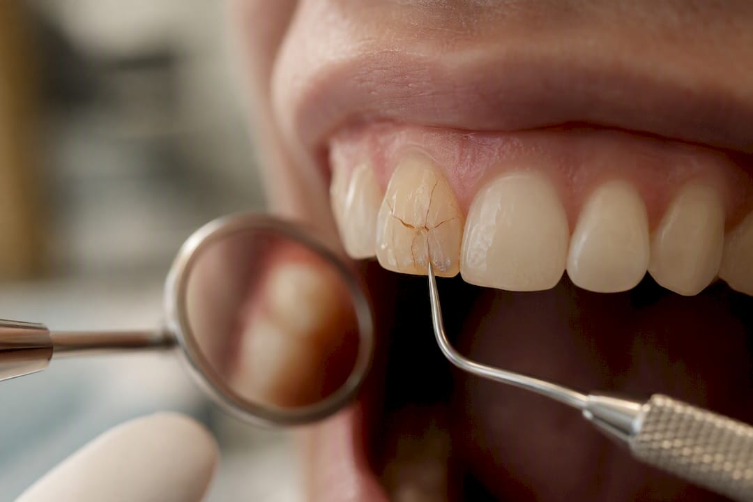 Close-up of cracked tooth under dental light
