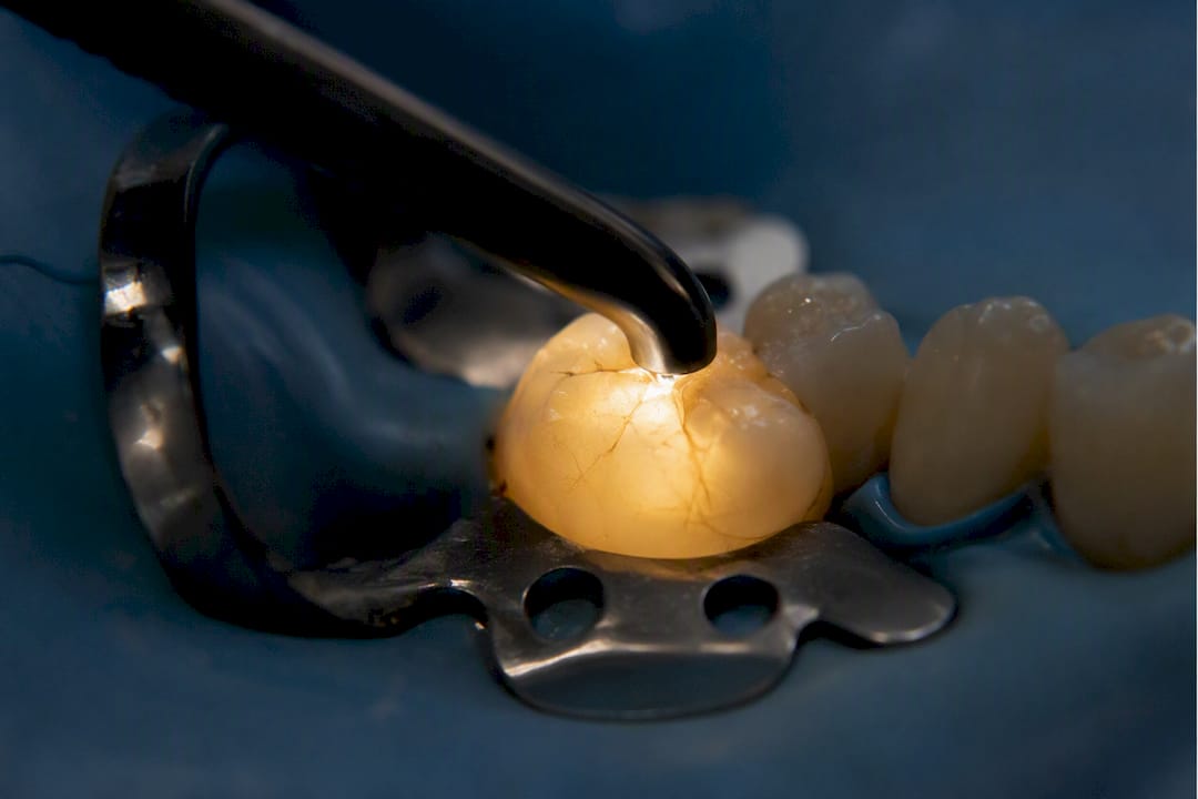Dental light revealing tooth crack via transillumination