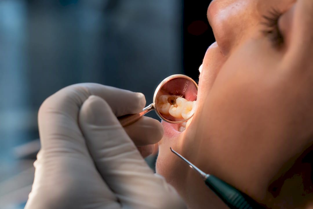 Molar showing a lost dental filling