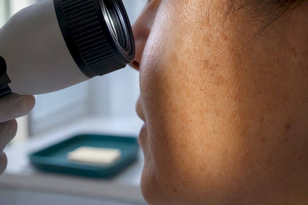 Brown sun spots examined during skin consultation