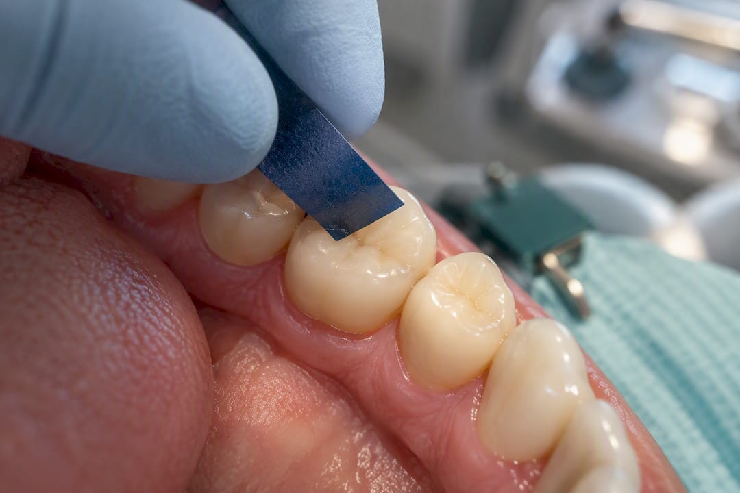 Dentist checking contact on crowned molar