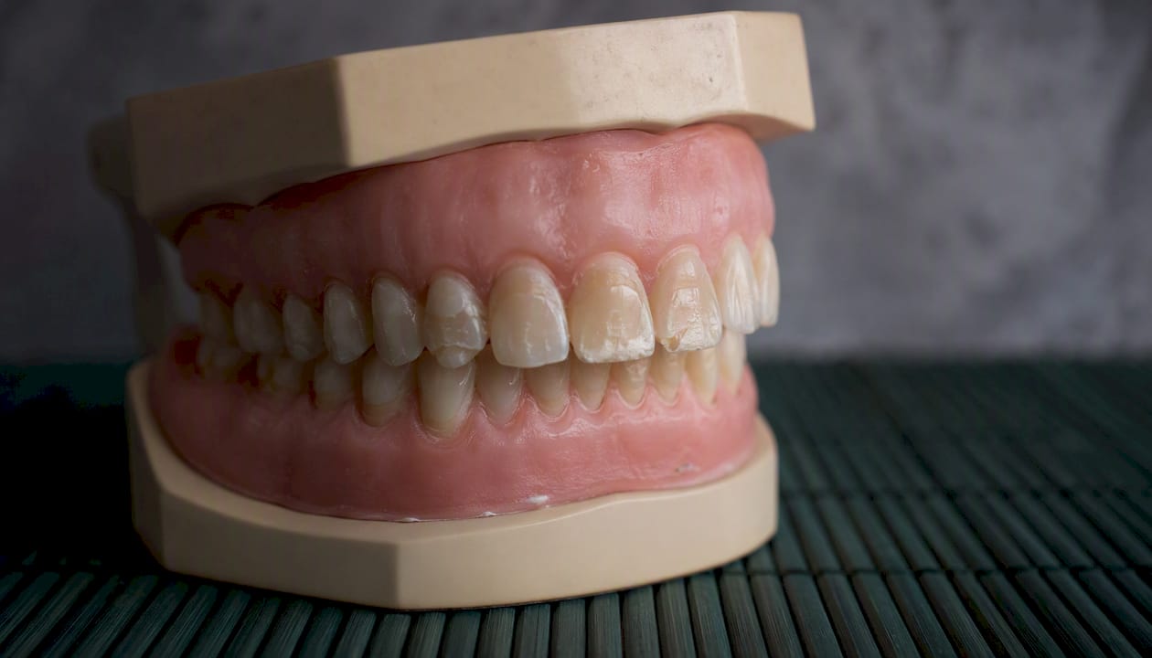Dental model showing effects of dry mouth on teeth