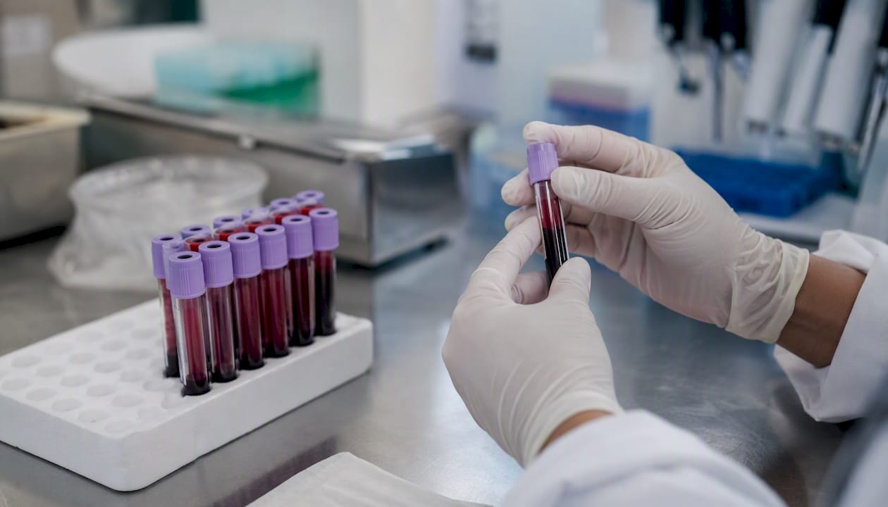 Hospital blood test for liver function injury