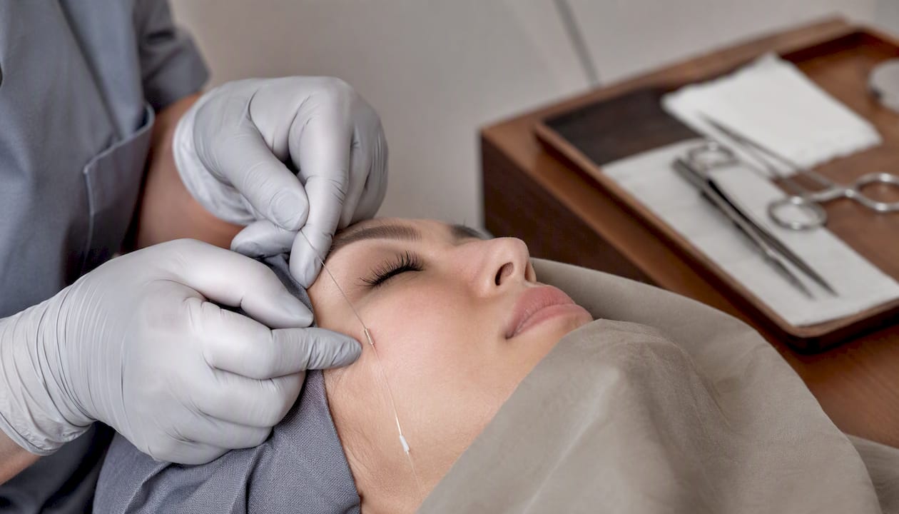 Close-up of thread lift procedure on patient's cheek