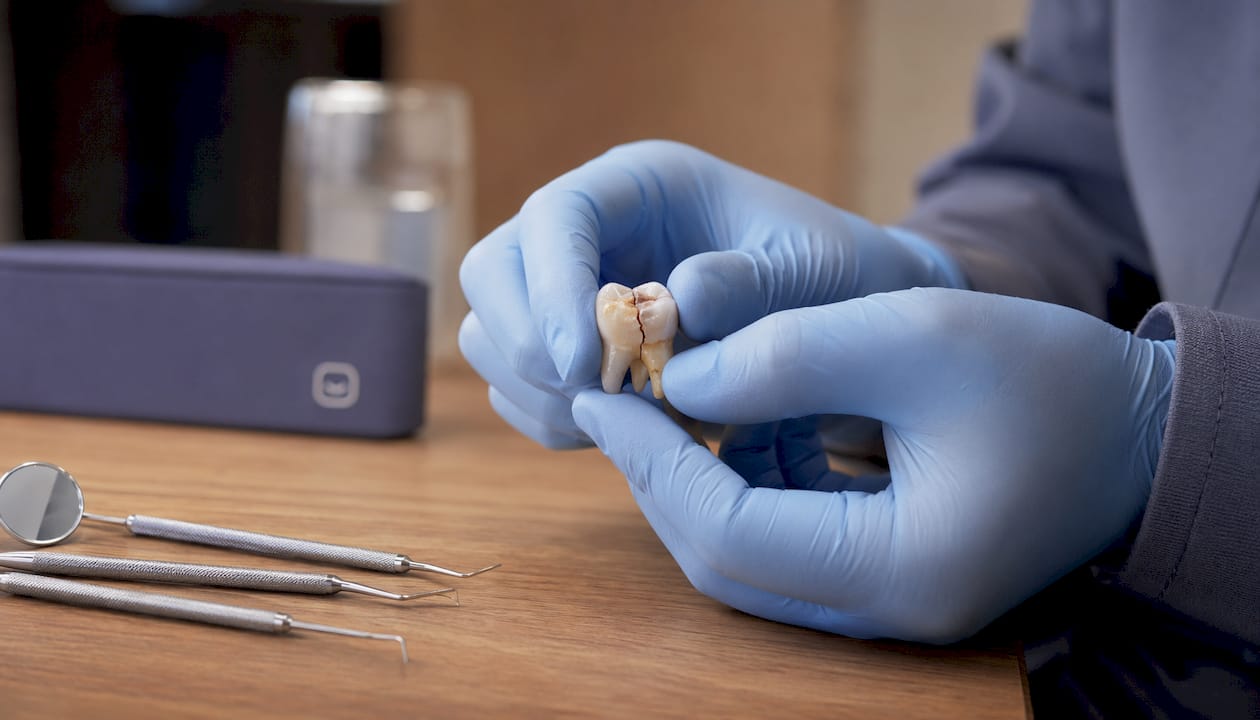 Close-up of fractured molar tooth by dentist's hands