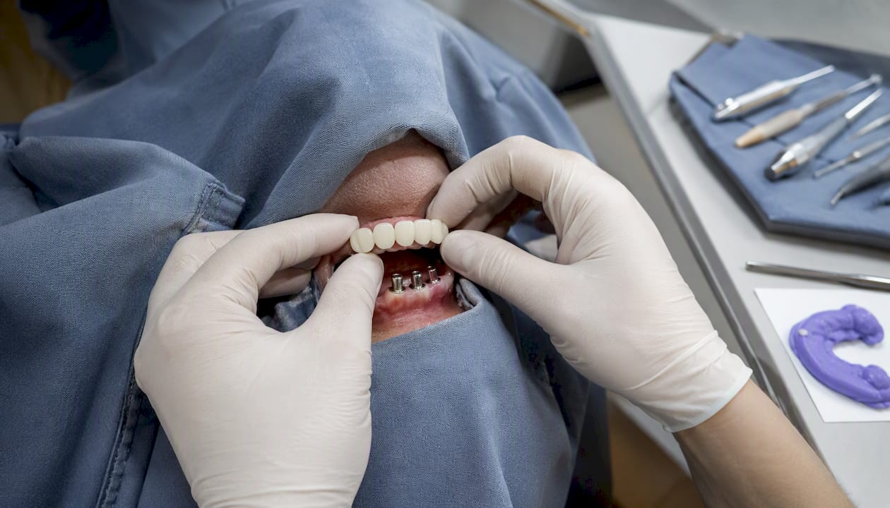 Hands placing provisional dental bridge on implants