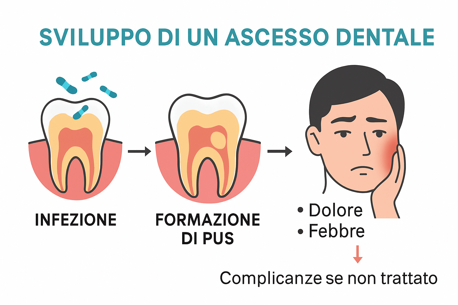 infographic showing stages and complications of a dental abscess