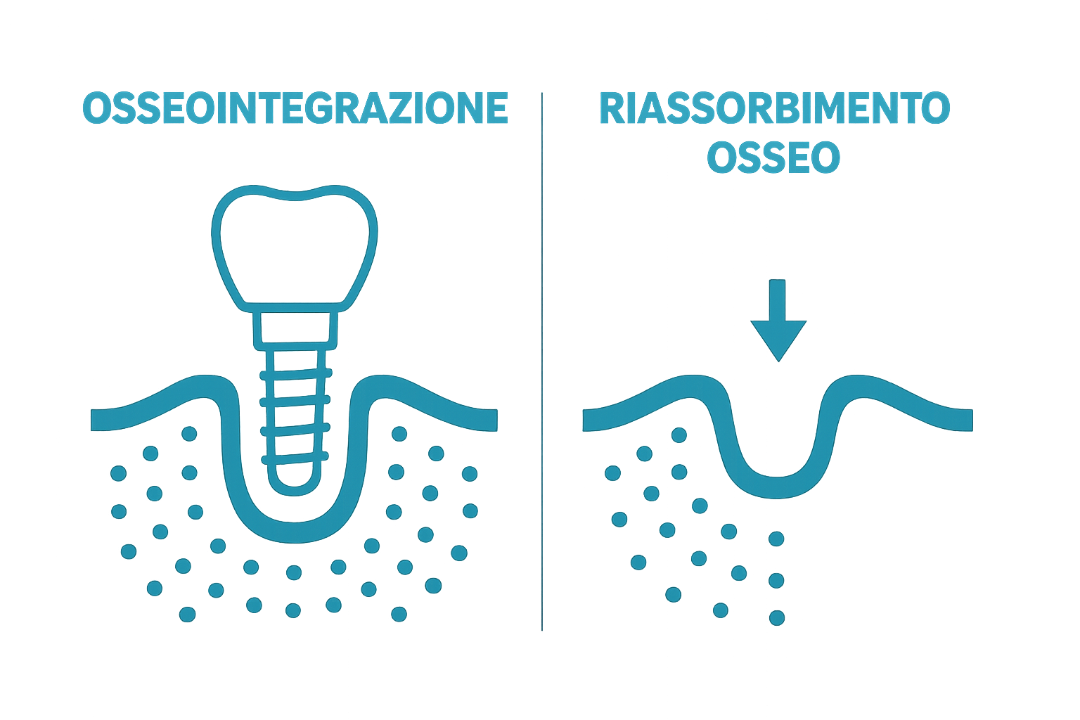 Simple infographic comparing bone preservation with implant vs bone loss after tooth loss