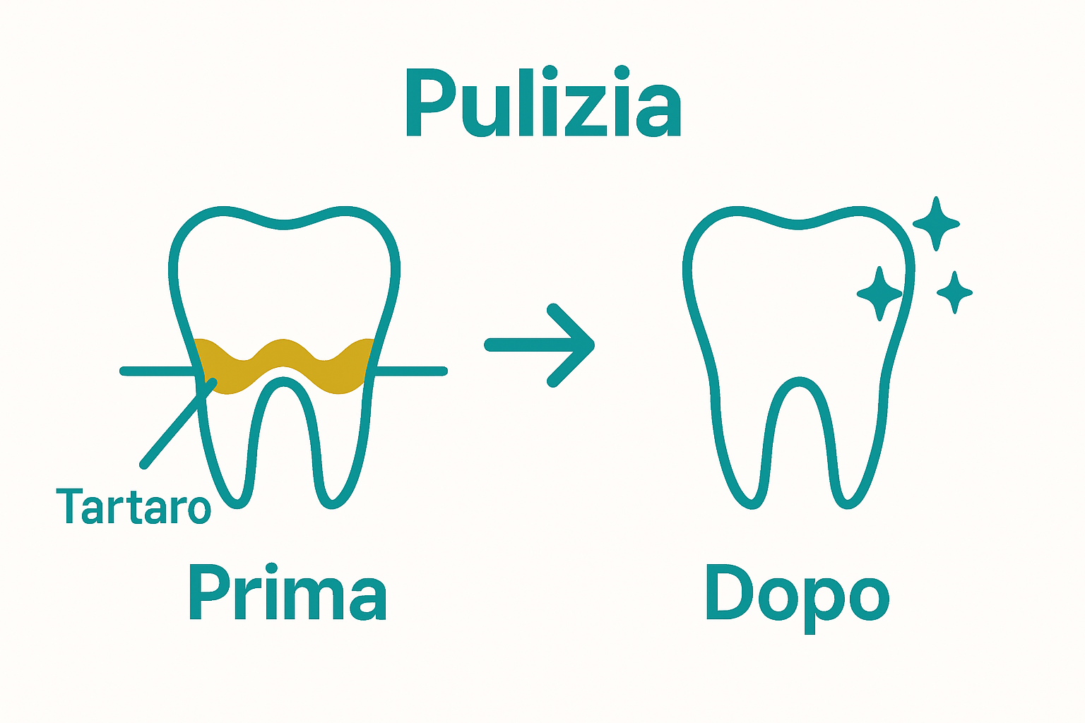 Prima e dopo la rimozione del tartaro da un dente