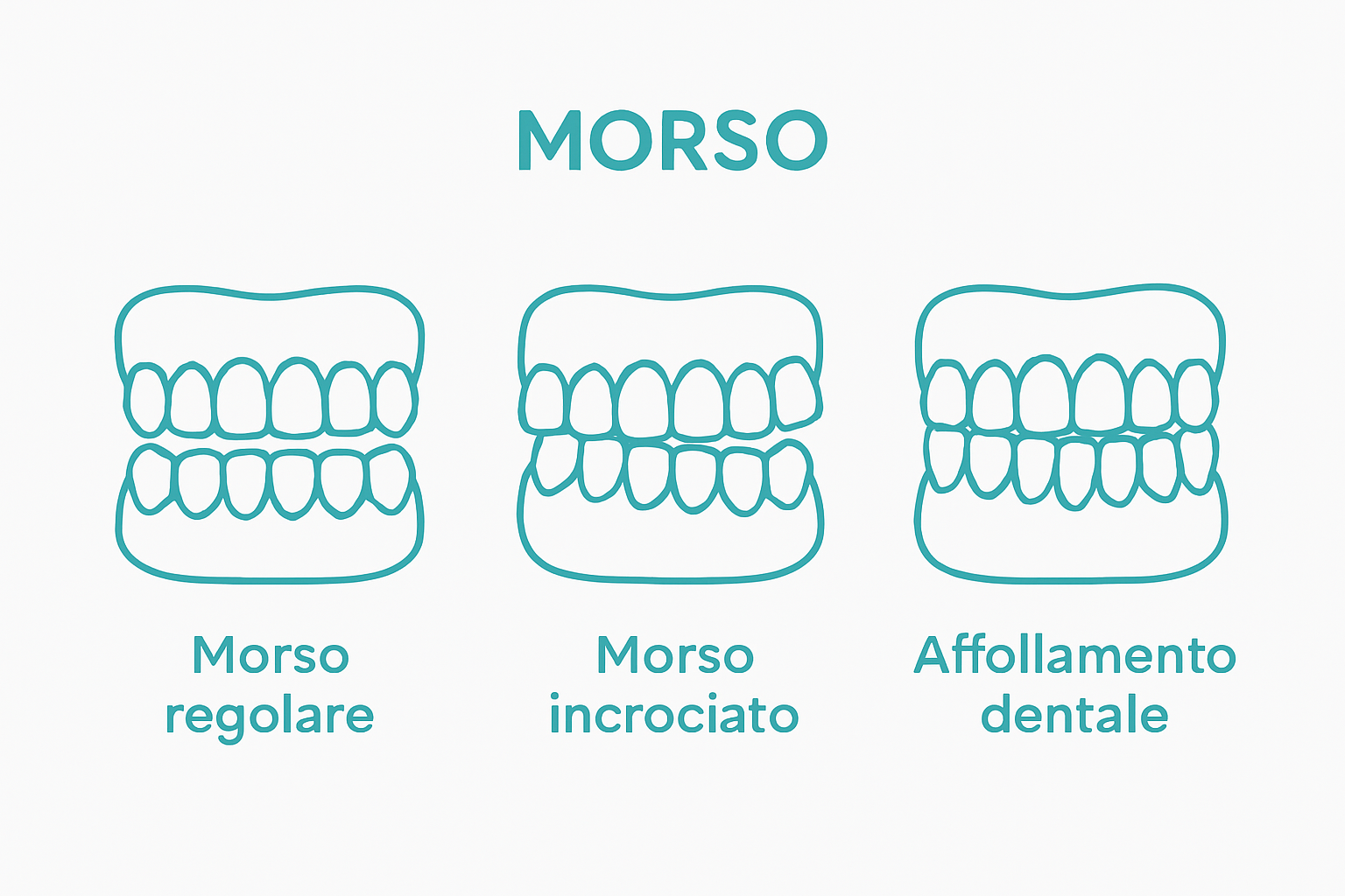 Infografica confronto tipi di malocclusione dentale