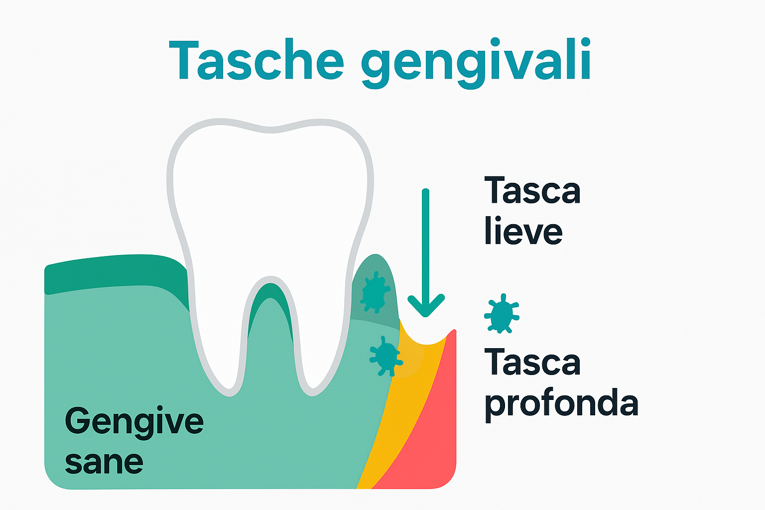 Three-stage gum pocket infographic with tooth and color zones