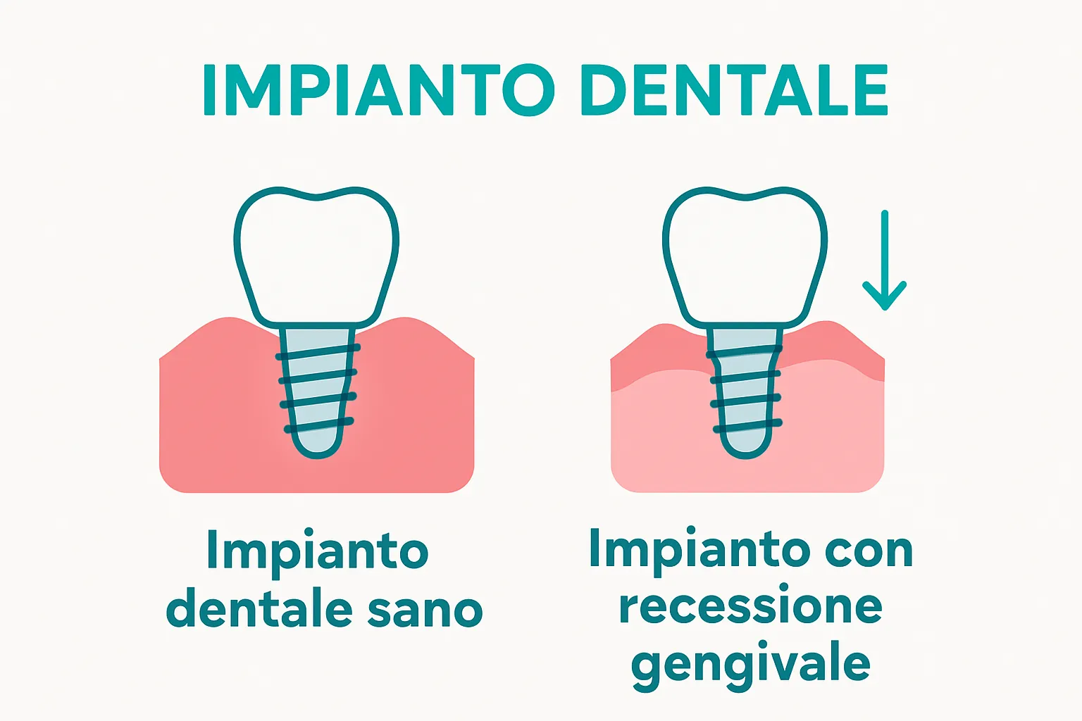 Confronto visivo tra impianto dentale sano e con recessione gengivale