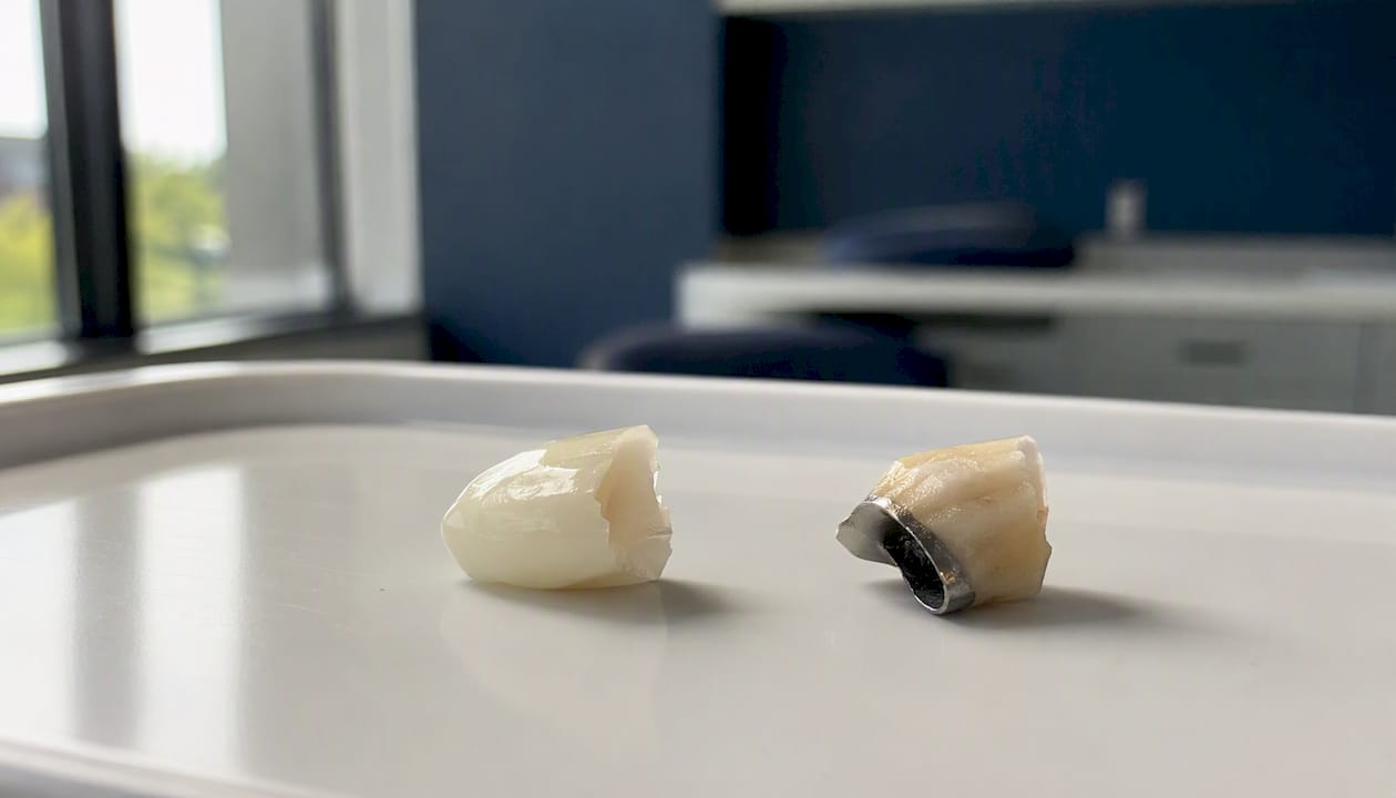 Close-up of zirconia and porcelain dental crowns