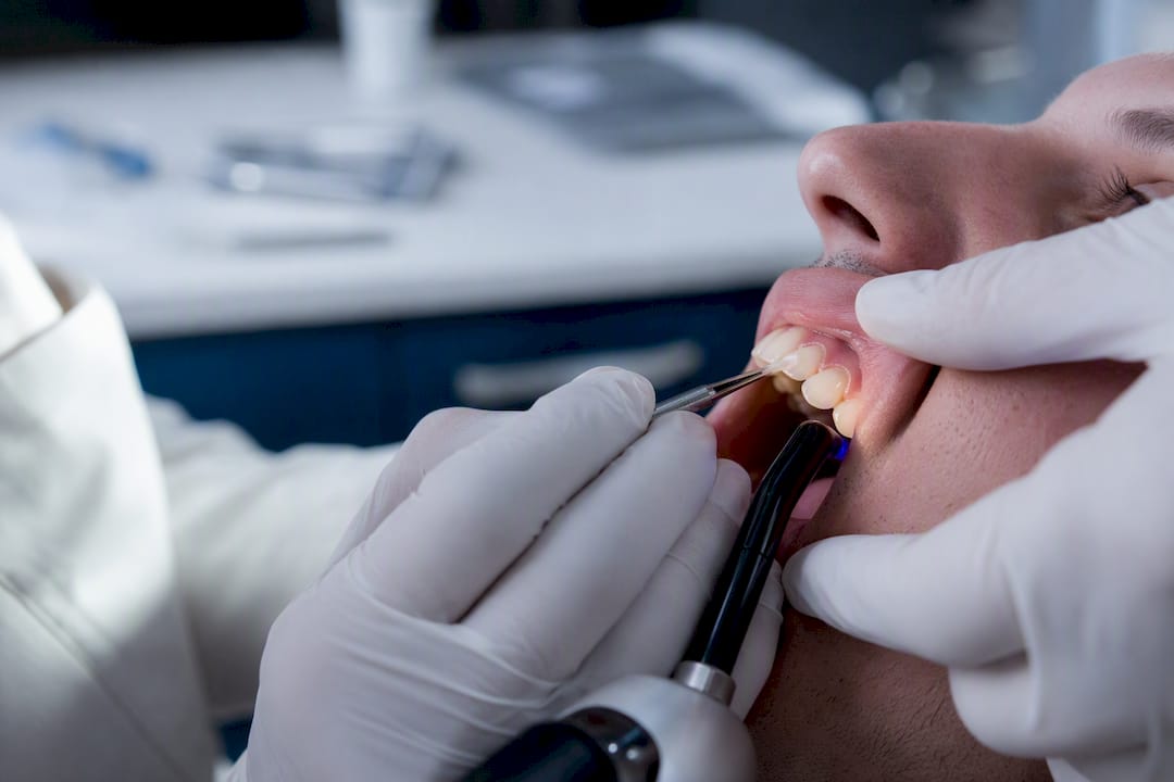 Dentist applying and curing tooth bonding resin