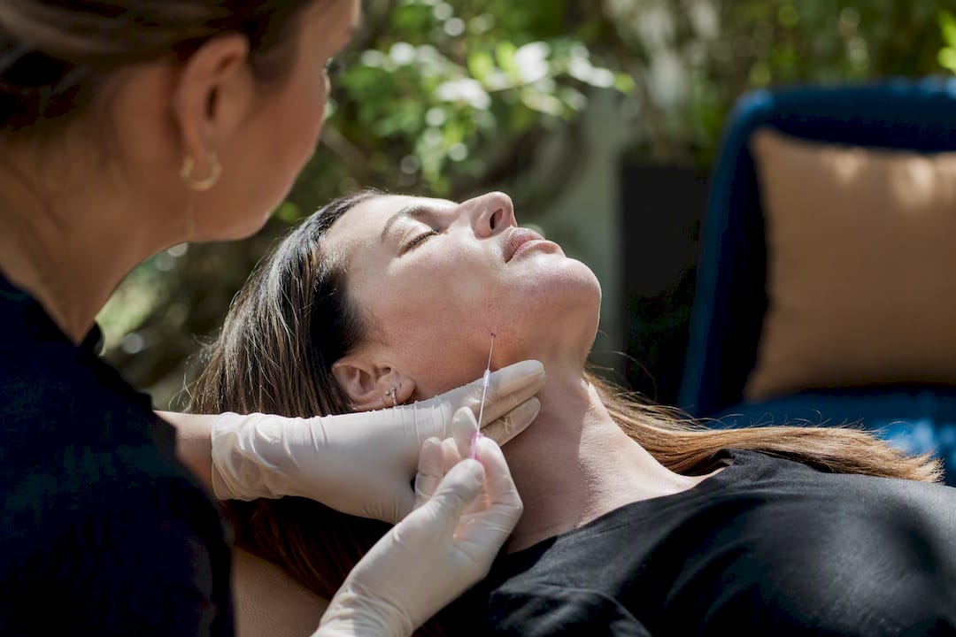 Clinician inserting PDO thread under jawline skin