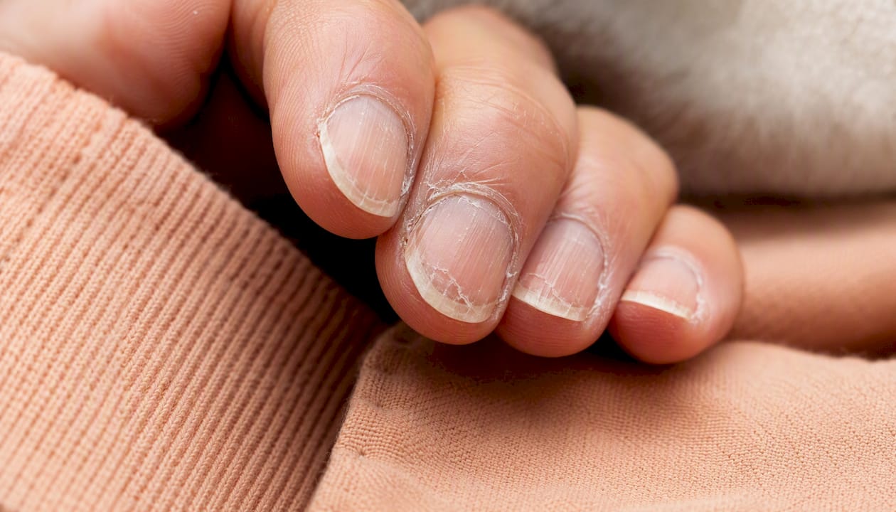 Close-up van broze, droge winternagels