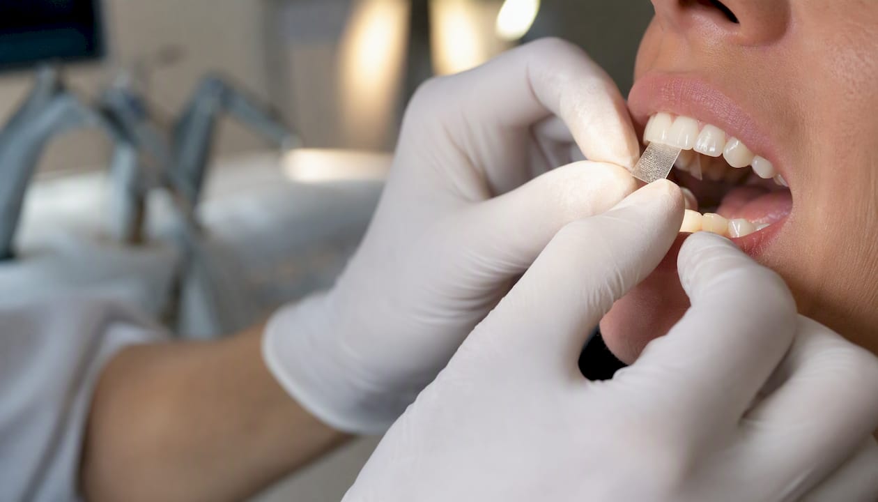 Dentist applying translucent whitening patch to teeth