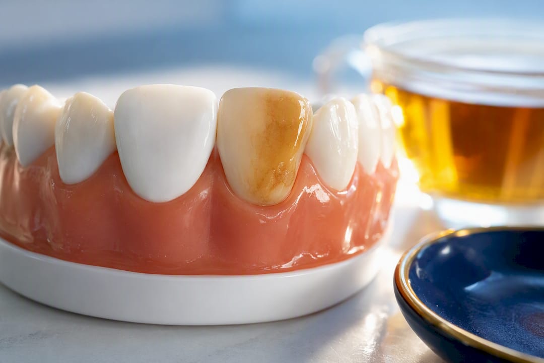 Tea-stained tooth beside dark tea