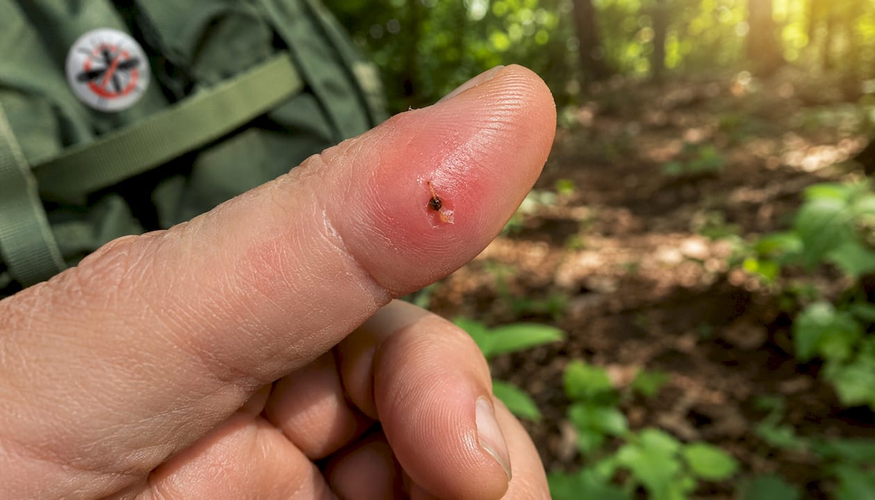 Close-up finger with bee stinger embedded
