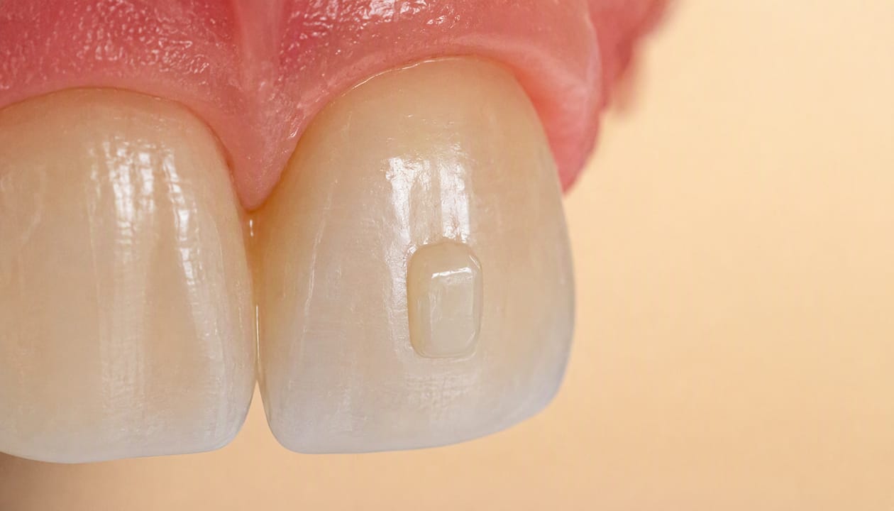 Close-up of tooth with composite attachment