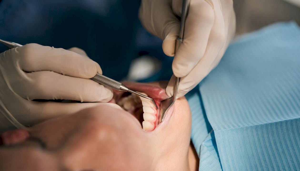 Dental professional hands performing gum contouring procedure