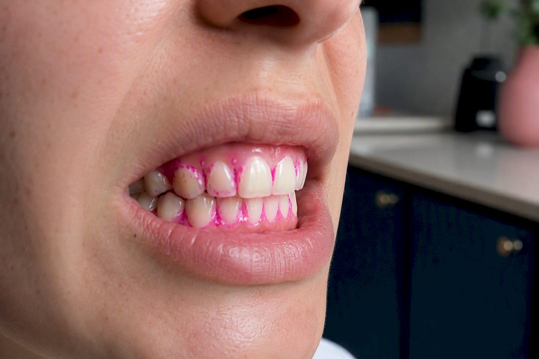 Plaque revealed by disclosing dye on teeth