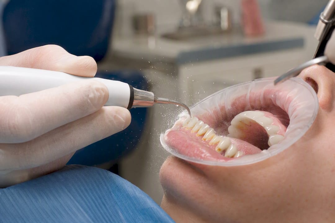 Ultrasonic scaler cleaning tooth roots