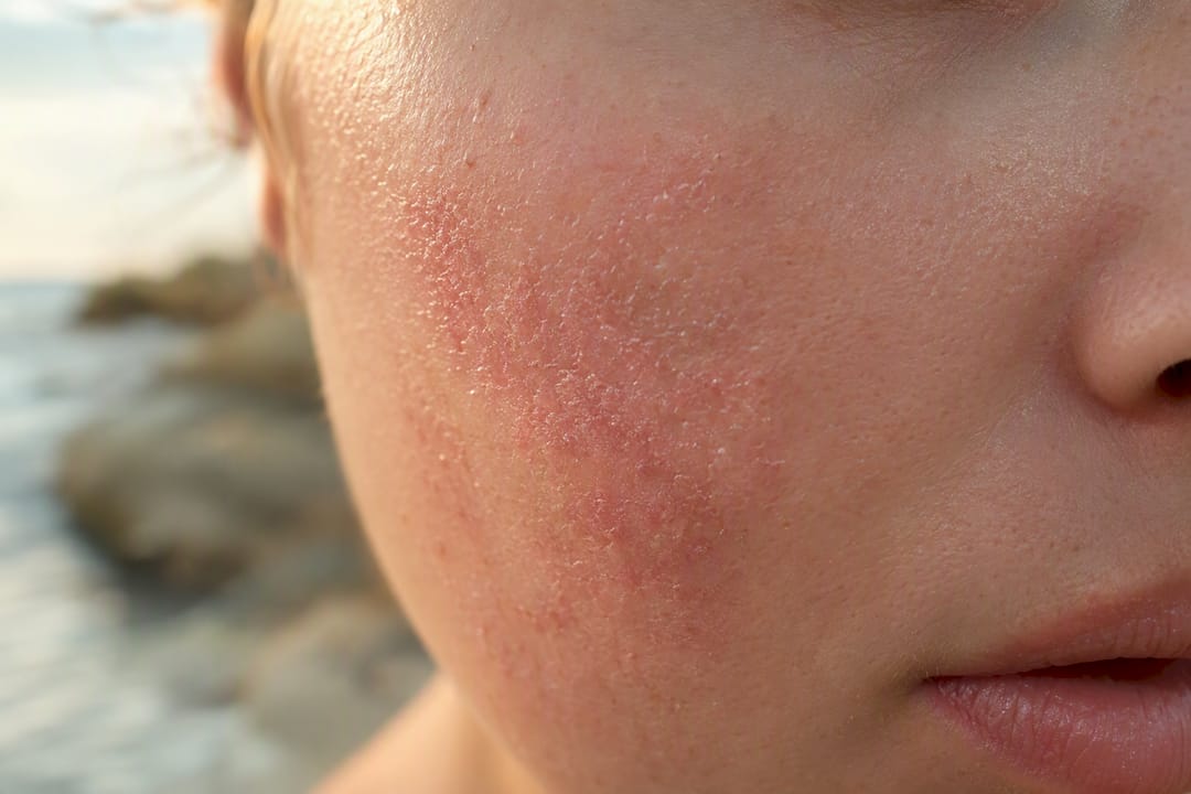 Close-up of inflamed and sensitive skin texture