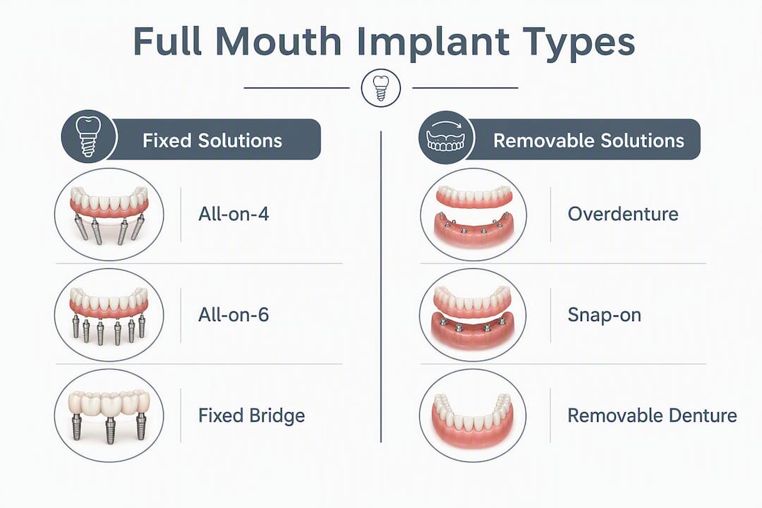 Infographic comparing full mouth implant types