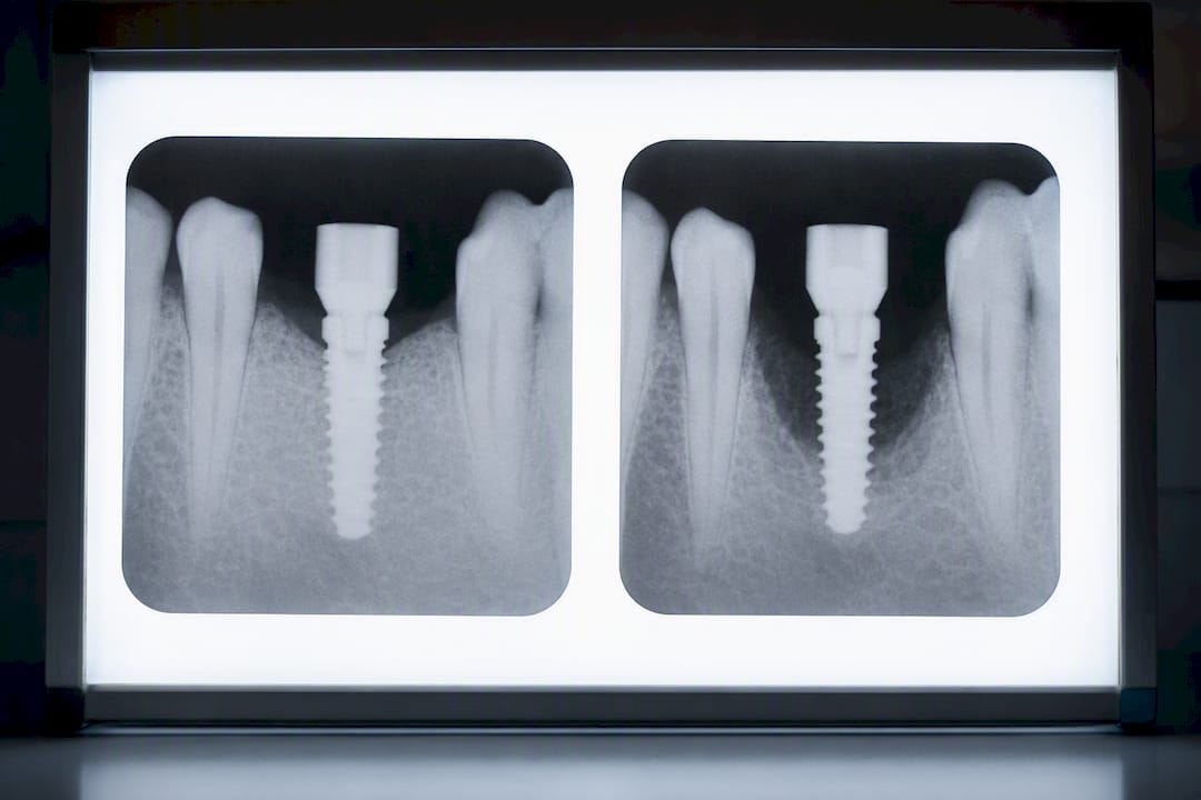 Side-by-side dental radiographs showing bone levels