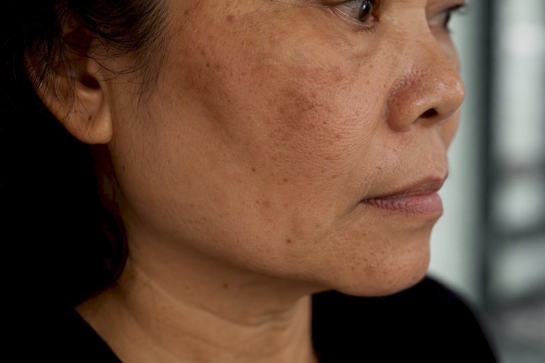 Skin under amber light revealing vascular detail