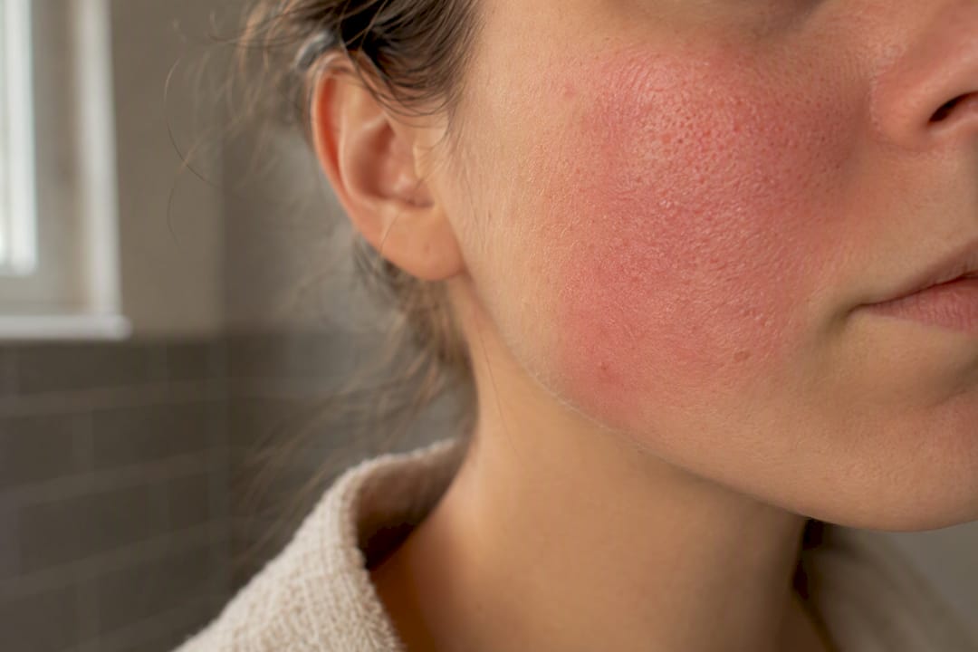 Close-up of skin with redness from LED therapy